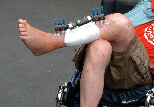 brokenleg
